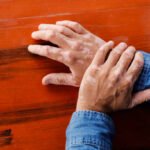 Vitiligo: What It Is, Why It Happens, and How It’s Managed