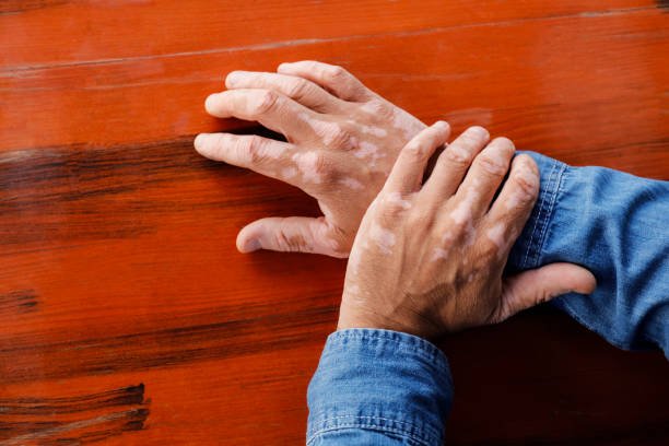 Vitiligo: What It Is, Why It Happens, and How It’s Managed