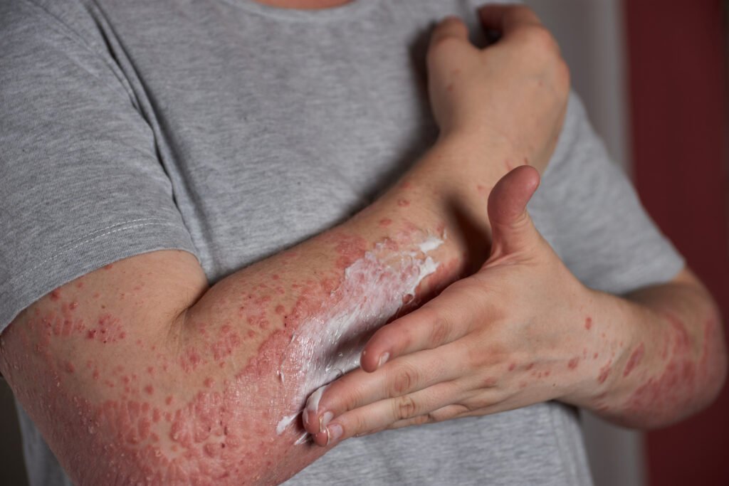 What Is Eczema? Causes, Symptoms, and Treatment Options