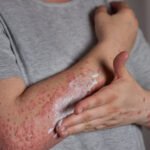 What Is Eczema? Causes, Symptoms, and Treatment Options